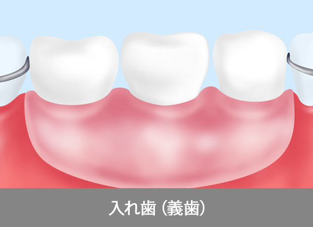 インプラント