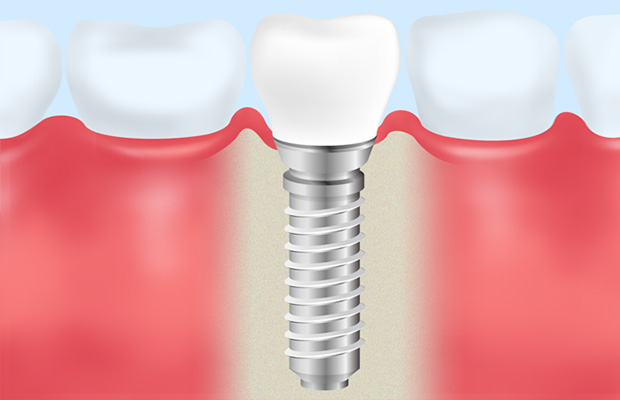 失った歯の機能と審美性を取り戻す「インプラント治療」