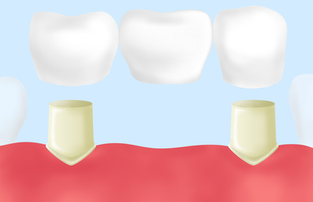 「ブリッジ治療」