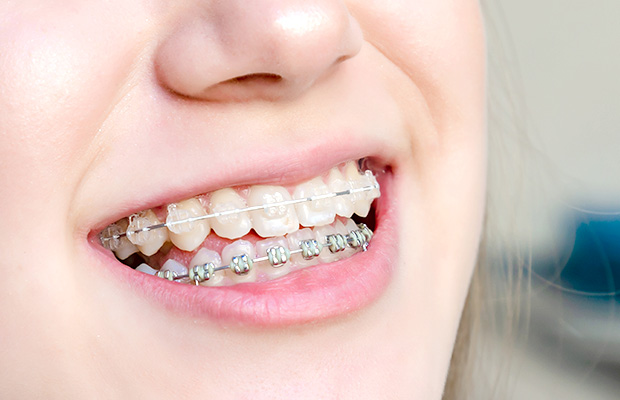 歯列矯正で、虫歯や歯周病を予防する
