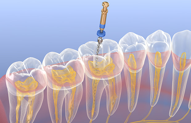 根管治療とは