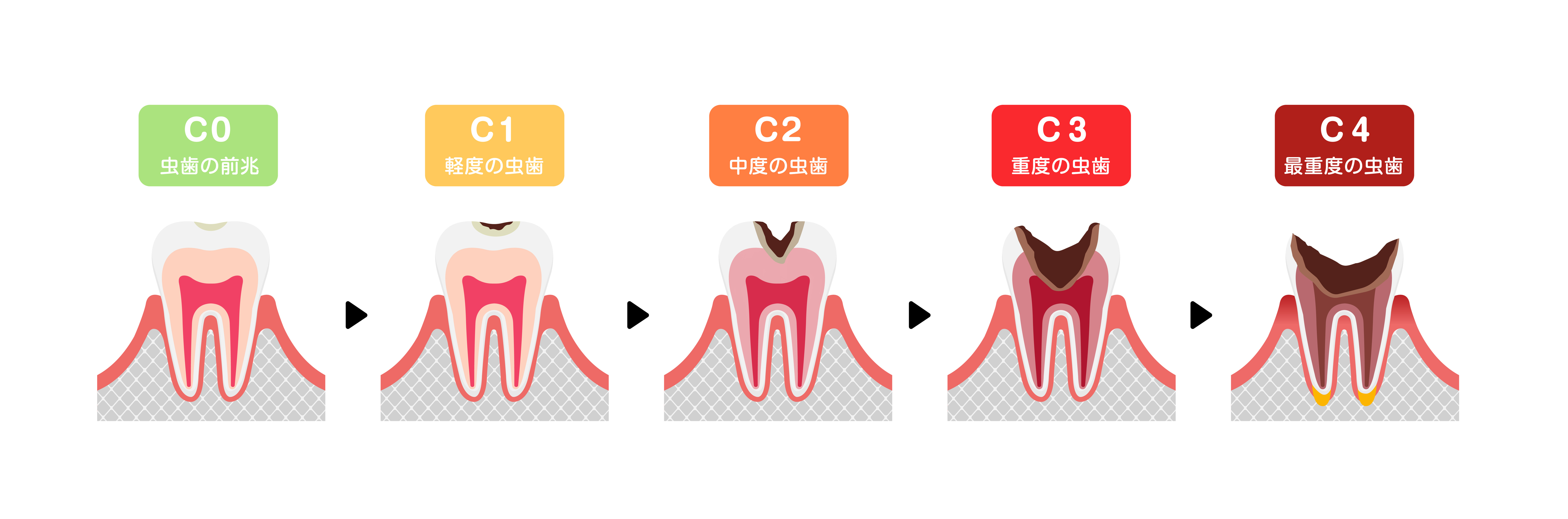 歯髄と虫歯の進行との関係